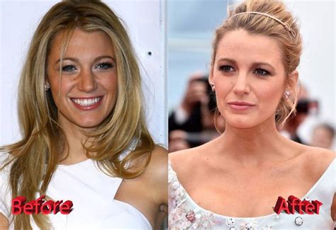 Blake Lively Plastic Surgery Before And After Blake Lively Plastic