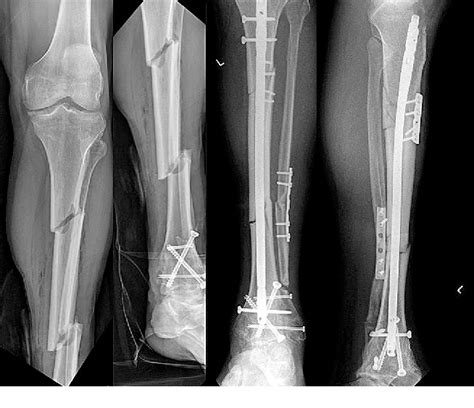 Figure 1 From Tibial Shaft Fractures Management And Treatment Options