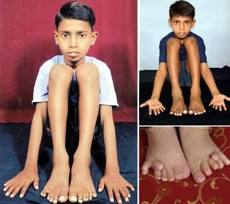 Devendra Harne And Pranamya Menaria Most Fingers And Toes World Records The Incredibles