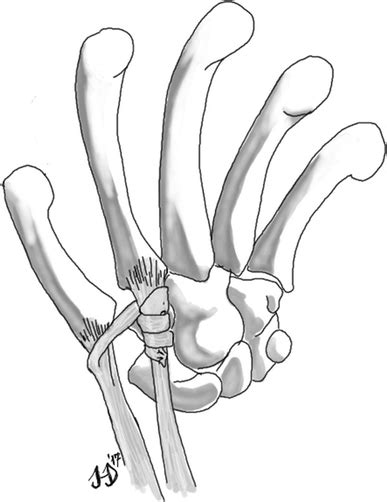 Illustration Of A Trapeziectomy Associated With An Abductor Pollicis