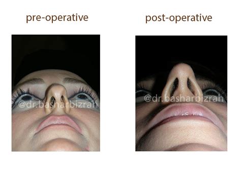 Wide Nose Bridge Wide Nasal Bridge Wide Nose Rhinoplasty Before And