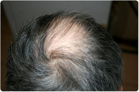 There are many triggers for hair loss and while some of them are caused by a poor diet or similar issues, others can be caused by drugs that you might be taking. Medications that Can Cause Alopecia / Hair Loss