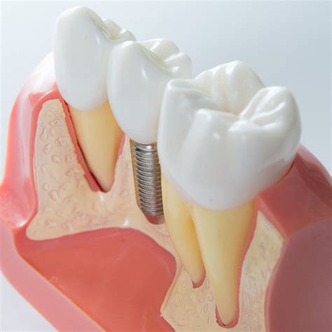 Caring For Your Dental Implants As Recommended By A Cosmetic Dentist