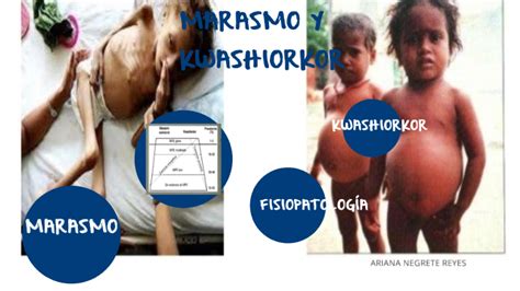 Marasmo Y Kwashiorkor By Oswaldo Aguirre On Prezi