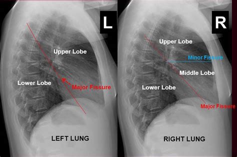 Labeled Lateral Chest X Ray