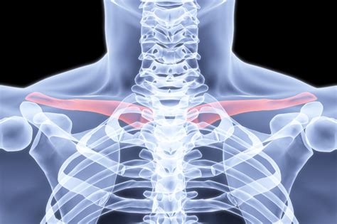 Clavicle Fracture Doctor Answers