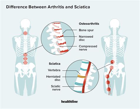 Arthritis Help 4 Friends What S The Difference Between Arthritis And Sciatica