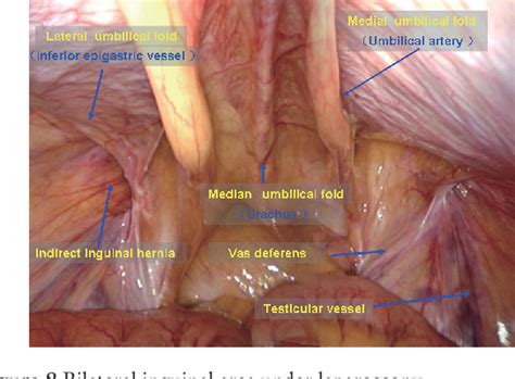 Figure From Anatomy Essentials For Laparoscopic Inguinal Hernia Hot Sex Picture