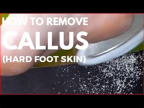 Remove the towel and wash up the callus. How to remove callus (Hard foot skin) - YouTube