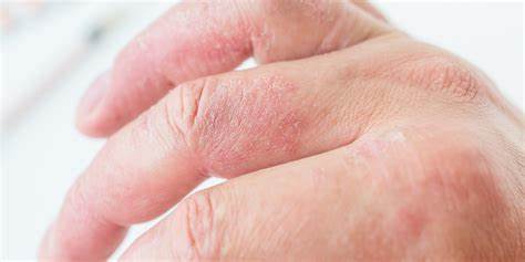 Диета 2 это химически стимулирующая Дерматит | что это, причины, симптомы, лечение, диагностика и профилактика Дерматит | что это, причины, симптомы, лечение, диагностика и профилактика Диета 2 это химически стимулирующая