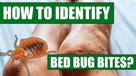 How To Identify Bed Bug Bites Can Doctors Or Exterminators Identify Bed Bug Bites Youtube