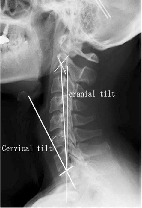 Measurement Of Cervical Sagittal Parameters Cranial Tilt The Angle