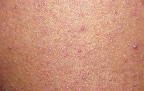 Red Itchy Bumps On Chest And Breasts Design Talk