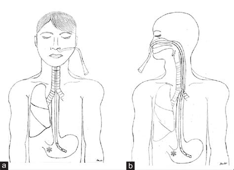 A And B Final Placement Of Properly Positioned Nasoenteric Tube Note