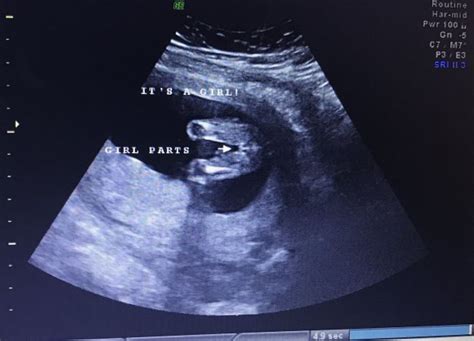 Its A Girl Ultrasound 16 Weeks