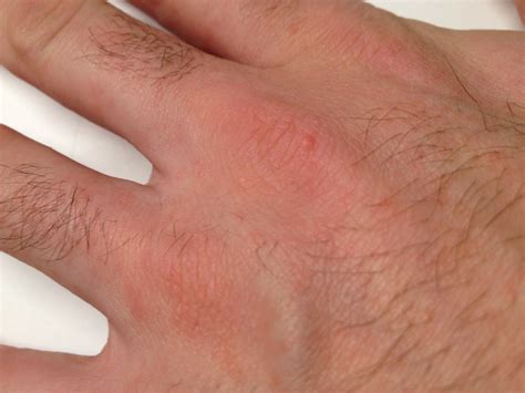 File Scabies Nodules Hand Wikimedia Commons