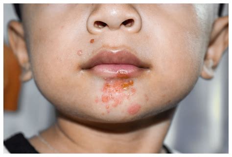 Impetigo In Toddlers And Children The Scratchsleeves Guide