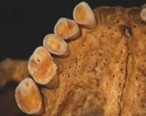 Occlusal Tooth Wear In Human Sculls Of Antique Period From Vendenis And