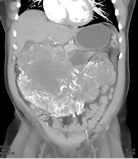 Large Abdominal Gist Tumor Gastrointestinal Case Studies Ctisus Ct