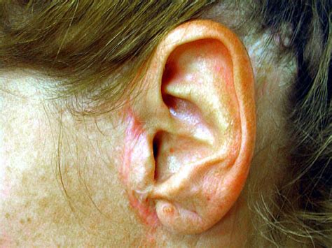 The meaning of the phrase wet behind the ears is someone who is very young, naive and inexperienced. Pixie Ear - Plastic Surgery: 10 Secret Signs - Pictures ...