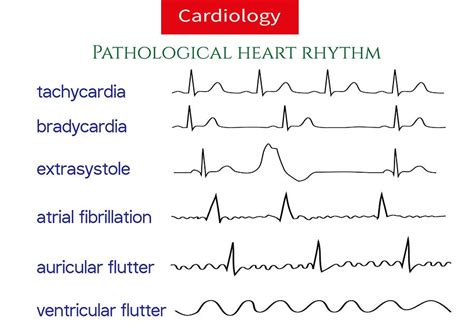 What Are Heart Arrhythmias The Heart Pumps About 70 Times In A By