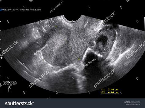 Transvaginal Ultrasound Uterus Bicornuate Uterus Transverse Stockfoto