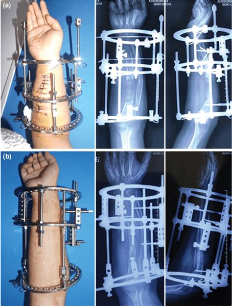 A Ilizarov Ring Fixators And The Hinges Were Installed And B