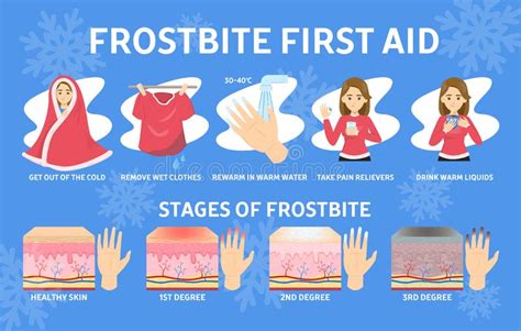 Frostbite First Aid Infographic Hypothermia In Cold Winter Stock