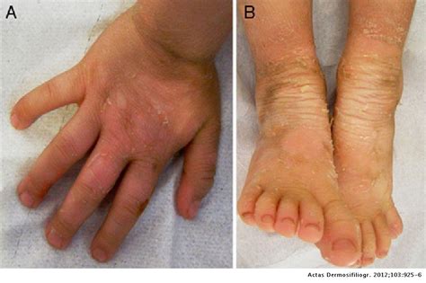 Hyperkeratosis And Scaling In Identical Twins Actas Dermo Sifiliográficas