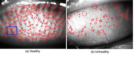 Detection Of Meibomian Glands And Classification Of Meibography Images