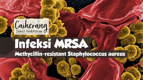 Infeksi Mrsa Methycillin Resistant Staphylococcus Aureus Kedokteran