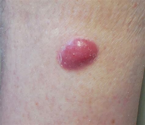 Mar 09, 2017 · merkel cell carcinoma (mcc) is a rare, aggressive skin cancer. Merkel Cell Carcinoma Warning Signs and Images - The Skin ...