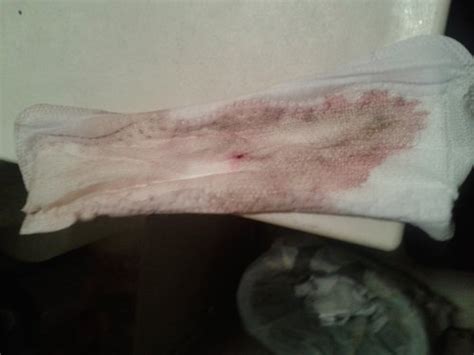 Tmi Picture Is This Implatation Bleeding Page 3 Babycenter