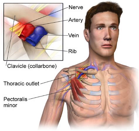 Thoracic Outlet Syndrome Anatomy Causes And Treatment