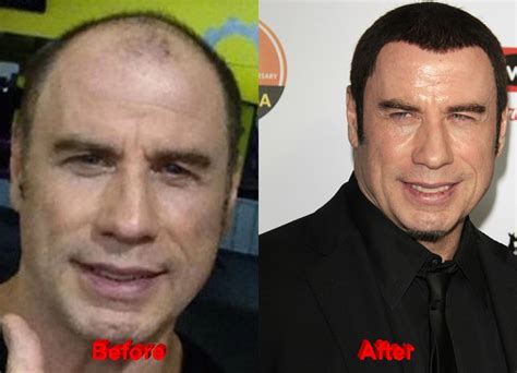 John Travolta Plastic Surgery Hair Before After