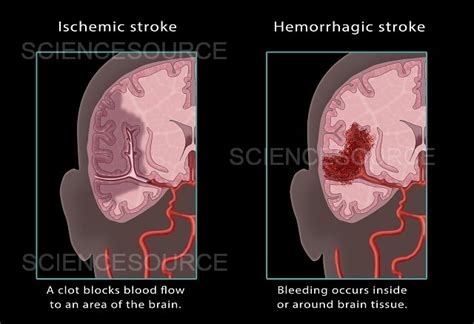 Photograph Ischemic And Hemorrhagic Stroke Illustr Science Source Images
