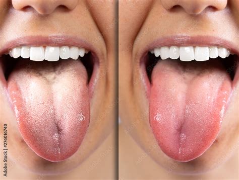 A Before And After View Of On The Tongue Of A Caucasian Girl She Sticks Her Tongue Out To