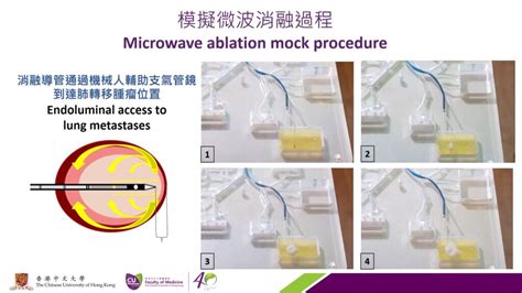 Cuhk Performs Worlds First Robotic Assisted Bronchoscopic Microwave