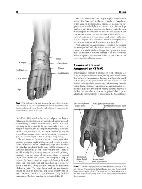 Toe And Partial Foot Amputations