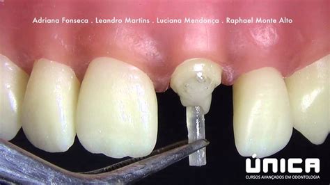 Pinos Anatômicos Dental Odontologia E Ortodontia