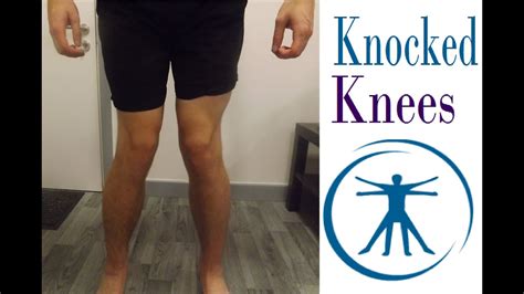 How To Fix Knocked Knees Genu Valgum With Correction Exercises Youtube