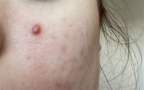 A Pimple That Wont Go Away Acne Rskincareaddiction