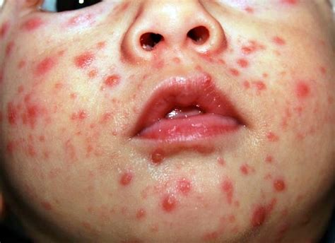 Raised pink or red bumps (papules), which break out over several days. 7 Chickenpox Home Remedies For Children