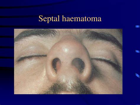 Ppt Nasal Obstruction Powerpoint Presentation Free Download Id