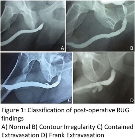 Pd Post Operative Retrograde Urethrogram Findings And Urethral