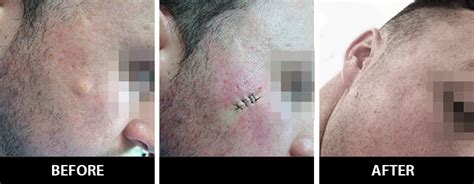 Cyst Removal Sebaceous Cyst Removal Treatment In London