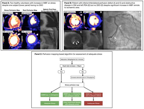 18 Quantitative Cmr Myocardial Perfusion Mapping To Assess Hyperaemic Response To Adenosine