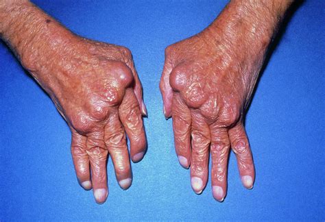 Hands With Rheumatoid Arthritis Photograph By James Stevenson Science Photo Library Pixels