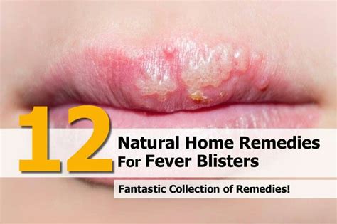 12 Home Remedies For Fever Blisters Fever Blister Home Remedies For