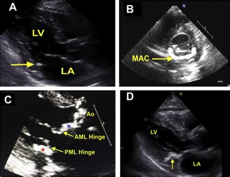 Mitral Annular Calcification And Calcific Mitral Stenosis Role Of